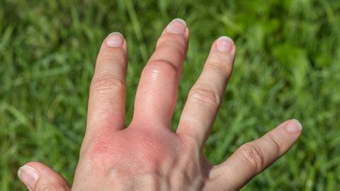 Si eres alérgico a las picaduras de abejas, se te formará un bulto elevado en la piel, en el lugar donde se hizo la prueba.
