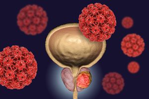 Conceptual image for viral ethiology of prostate cancer. 3D illustration showing Human Papilloma Viruses HPV infecting prostate gland which develops cancerous tumor
