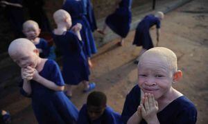 Campamento de acogida de niños albinos. Foto: AFP. 