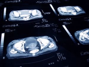 Radiografía de un examen de Cáncer de próstata.