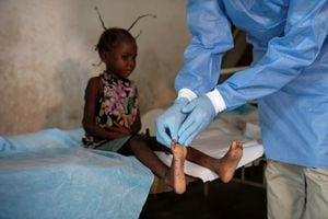 Angelika Lifafu, de 6 años, tiene forúnculos en los pies revisados por Theopiste Maloko, de 42 años, un funcionario de salud local, antes de tomar muestras de piel para detectar la viruela del mono, en el centro de salud de Yalolia, en Tshopo, República Democrática del Congo, el 3 de octubre de 2022.