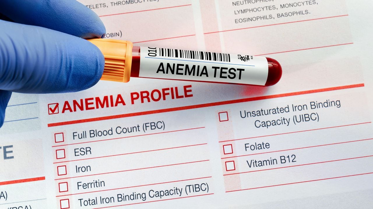 La anemia consiste en la deficiencia de glóbulos rojos.
