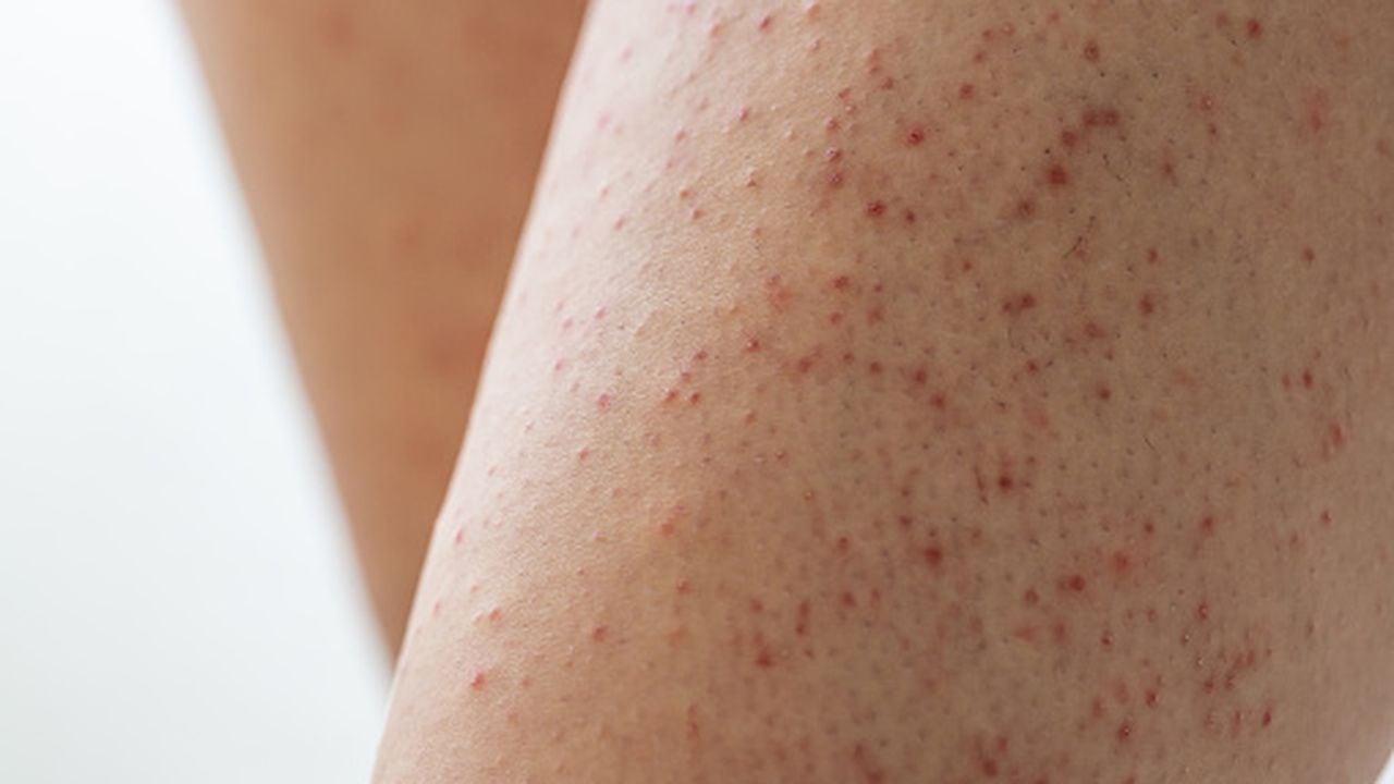 Queratosis pilaris afecta en la piel.