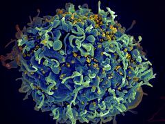 Esta imagen de microscopio electrónico proporcionada por los Institutos Nacionales de Salud de EE. UU. muestra una célula T humana, en azul, atacada por el VIH, en amarillo, el virus que causa el SIDA. Tres mujeres a las que se les diagnosticó VIH después de someterse a procedimientos “faciales vampíricos” en un spa médico no autorizado de Nuevo México son las primeras que se cree que contrajeron el virus a través de un procedimiento cosmético con agujas, según funcionarios federales de salud.