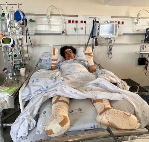 Luz Marina tiene afectaciones en sus dos manos y sus dos pies, con riesgo de amputación