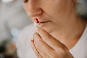 Woman wiping her bleeding nose with tissue