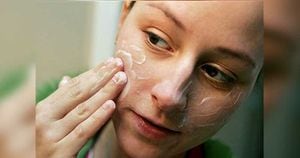 El aumento hormonal durante la adolescencia puede ser una de las causas del acné.