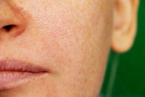 Los desordenes hormonales pueden aumentar la aparición de poros abiertos en la piel del rostro.