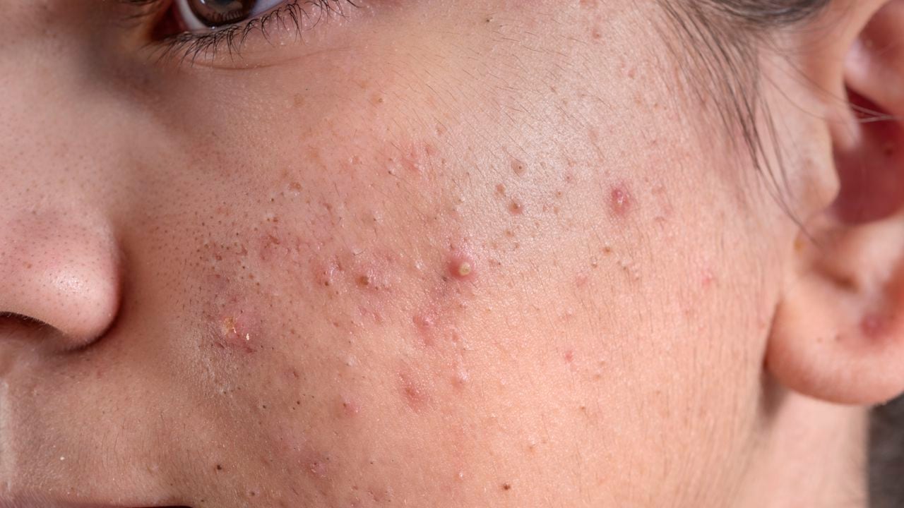 vesícula biliar masa negar Cicatrices por acné: cómo eliminarlas con remedios naturales