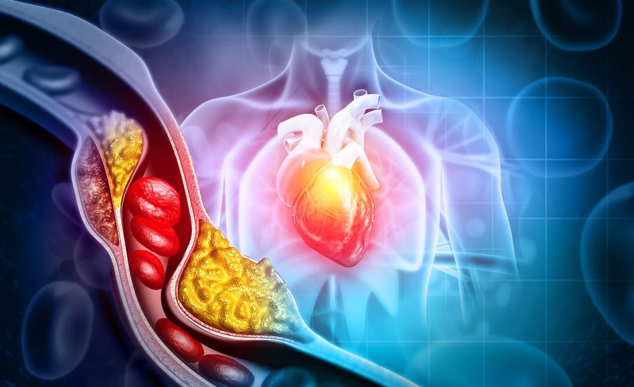 El colesterol alto puede provocar un ataque cardíaco.
