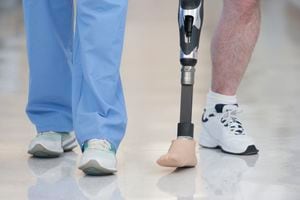 Debido a los altos costos, solo uno de cada 10 personas en el mundo que necesitan una prótesis, tiene acceso a ella.