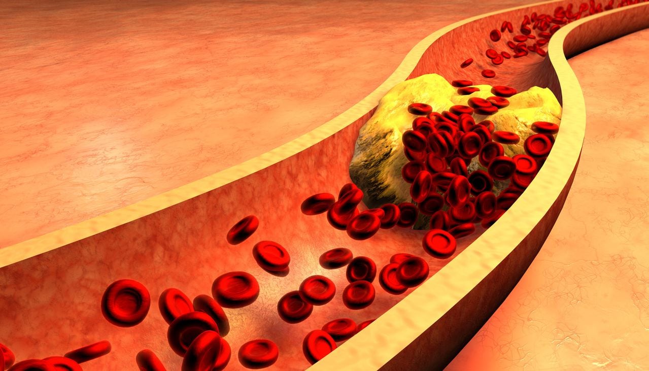 El colesterol alto se relaciona con la ingesta de alimentos ricos en grasa.