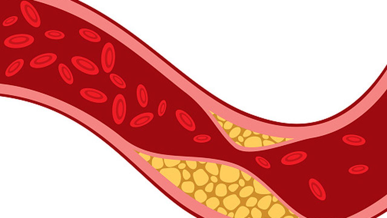 El colesterol LDL se incrementa por un plan de alimentación rico en grasa.