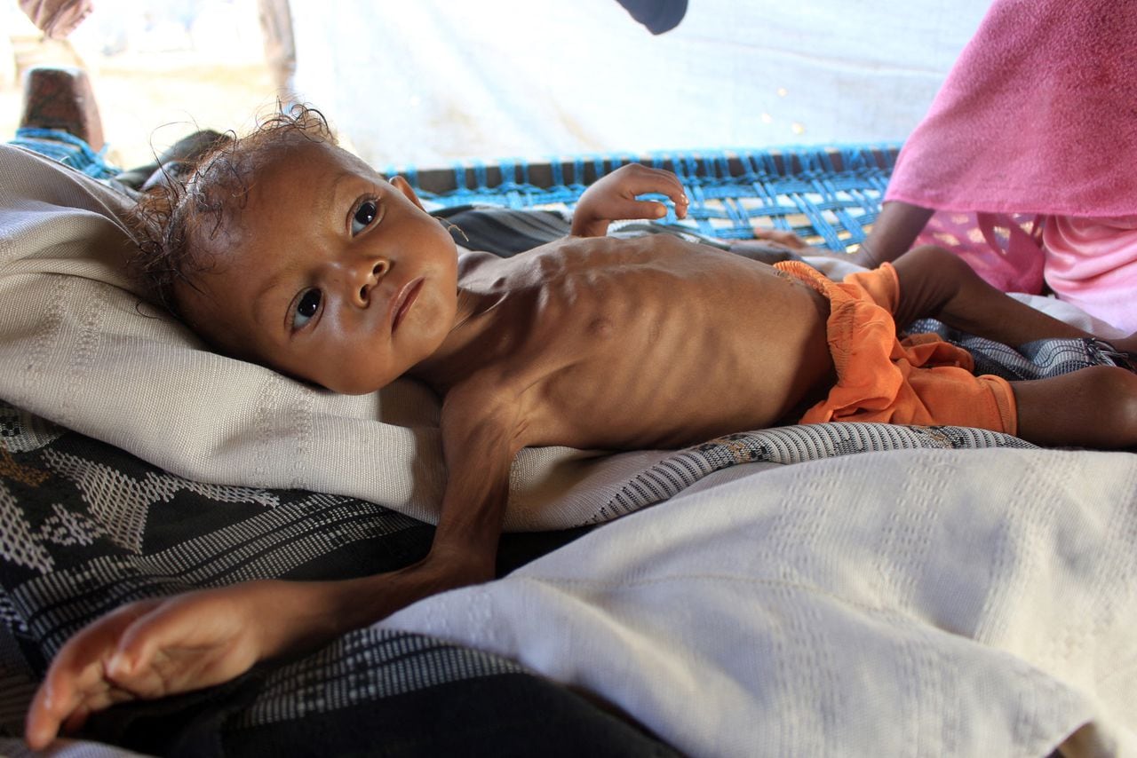 La niña yemení de tres años, Randa Ali, que pesa solo cuatro kilos (menos de nueve libras) y sufre de desnutrición aguda, aparece en el campamento de Al-Khudash para personas desplazadas en el distrito de Abs en la gobernación de Hajjah, en el noroeste de Yemen, el 22 de diciembre. 2021. - Randa, de tres años, llorando y luchando por respirar, todavía está sentada en una cama de metal en una tienda de campaña en la provincia de Hajjah, en el noroeste de Yemen, con un peso similar al de un recién nacido sano. Al igual que millones en todo el país devastado por la guerra y cientos de niños en la provincia, Randa tiene hambre y sufre de desnutrición aguda severa, exacerbada por las condiciones desesperadas. Una guerra civil de siete años entre las fuerzas progubernamentales y los rebeldes huzíes ha llevado al país al borde de la hambruna con cientos de miles de muertos estimados y millones de desplazados en lo que Naciones Unidas llama la peor crisis humanitaria del mundo. (Foto de ESSA AHMED / AFP)