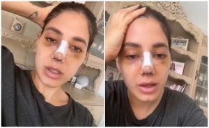Mujer se volvió viral en TikTok después publicar video en el que contó su experiencia tras realizarse una rinoplastia.