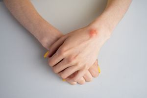 En ocasiones las masas que aparecen en las manos pueden estar relacionadas a otras lesiones.