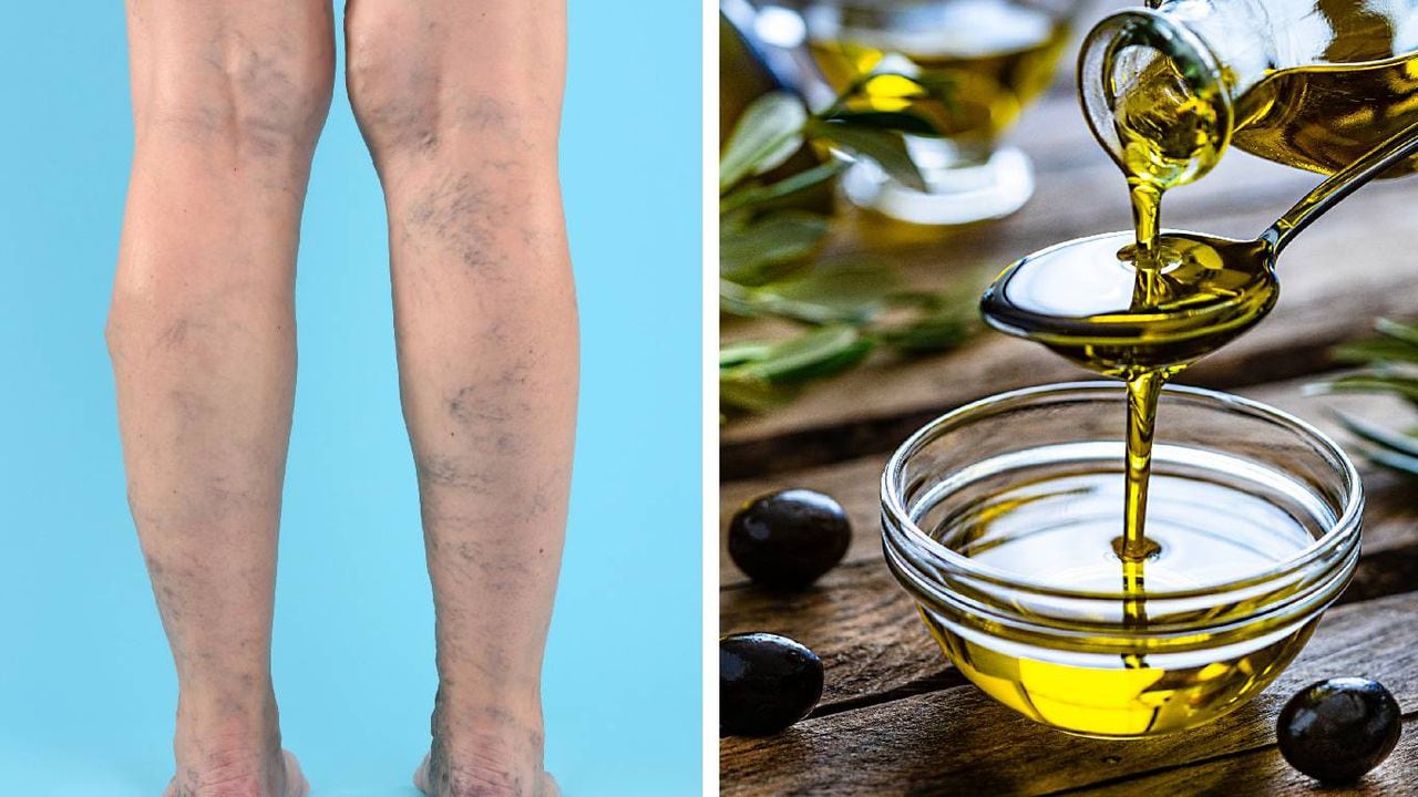 tensión Pintura siga adelante Venas varices: ¿cómo tratar el dolor con aceite de oliva?