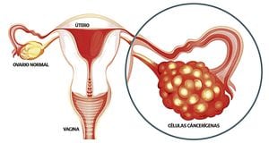 El cáncer de ovario no se encuentra entre el mencionado grupo de tipos de cáncer priorizados en el Plan Decenal para el Control de Cáncer en Colombia  2012-2021