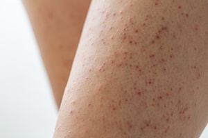 Queratosis pilaris afecta en la piel.