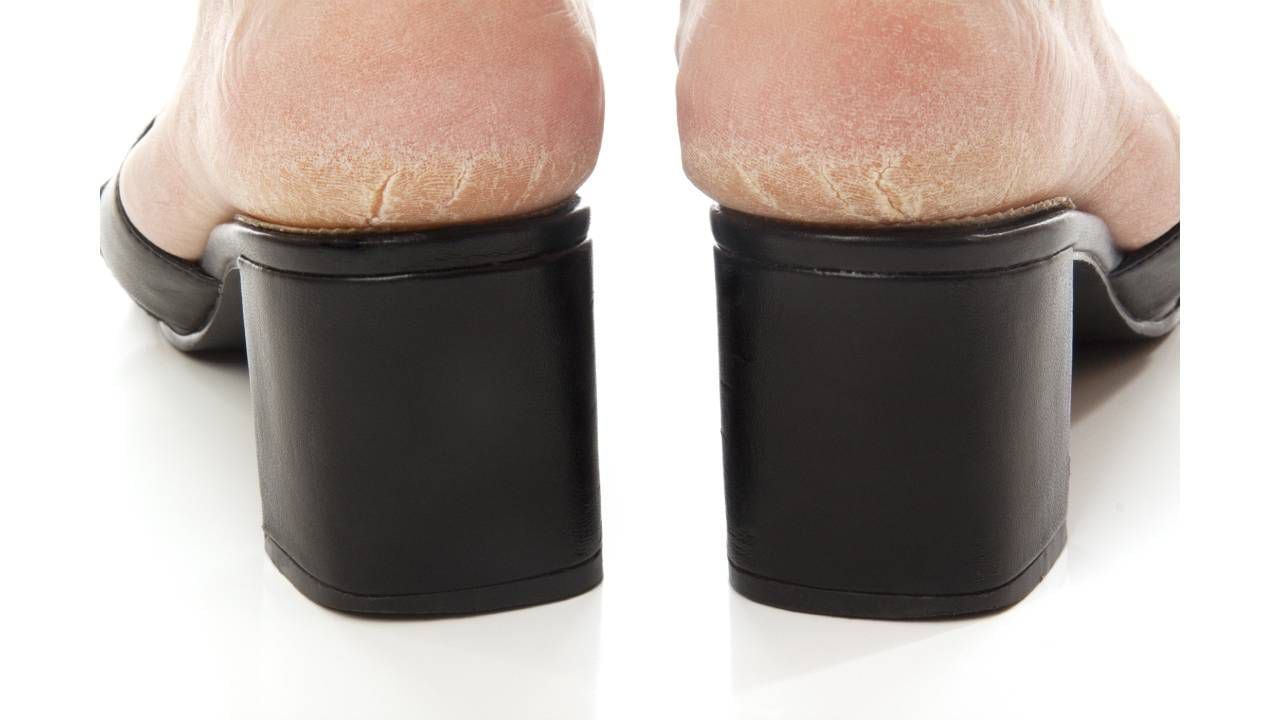 Cómo eliminar los callos de los pies con remedios caseros?