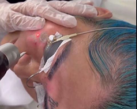 Yina Calderón empezó el proceso para quitarse dos de los cinco tatuajes quue tiene en el rostro.