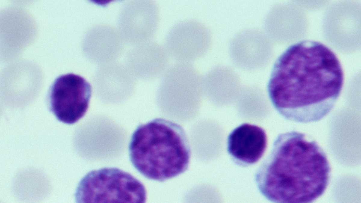 Linfoblastos (linfocitos inmaduros, las cuatro células más grandes) y linfocitos (las tres células más pequeñas con un borde delgado de citoplasma), 400X. Las muy numerosas células grises son glóbulos rojos. La leucemia es un cáncer de los glóbulos blancos (leucocitos), la gran poliferación de células puede desplazar a las células sanas que producen glóbulos rojos y plaquetas y glóbulos blancos normales. La leucemia aguda se encuentra más comúnmente en niños.