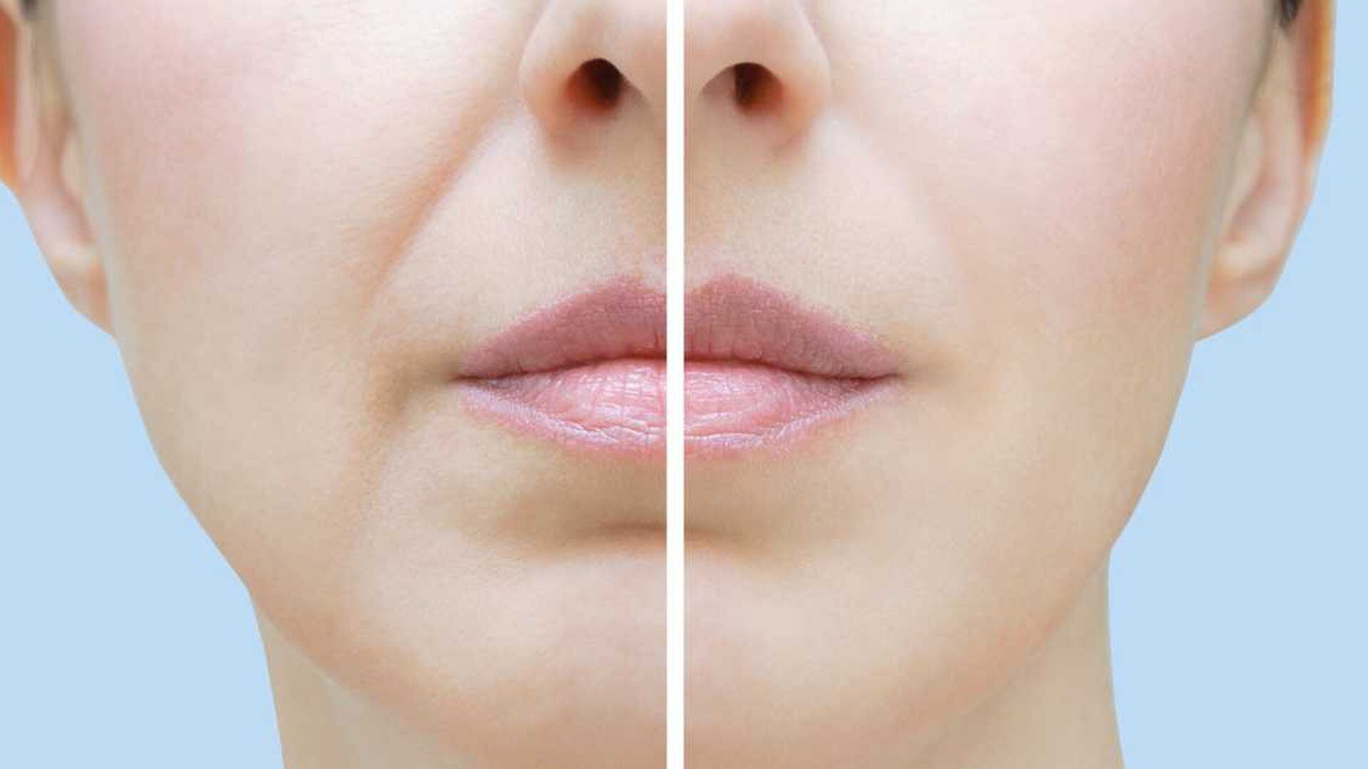 Nervio provocar carencia Cómo eliminar las arrugas alrededor de la boca con remedios caseros?