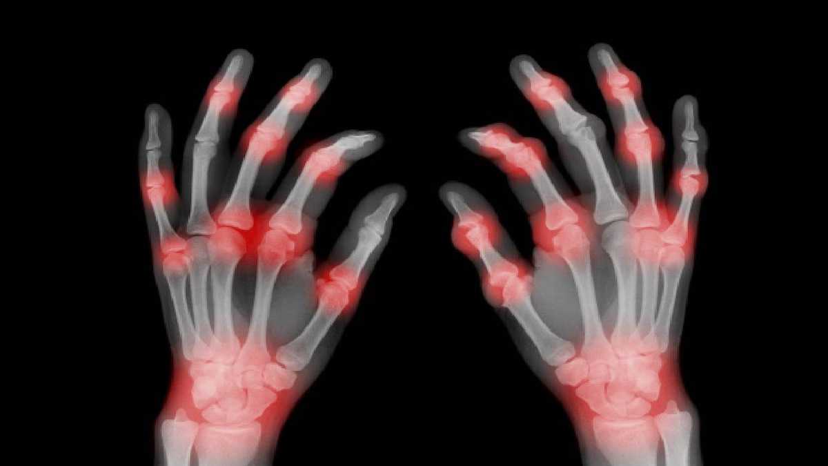 La artrosis se causa por el desgaste del cartílago que cubre las uniones entre huesos. Foto: Getty Images.