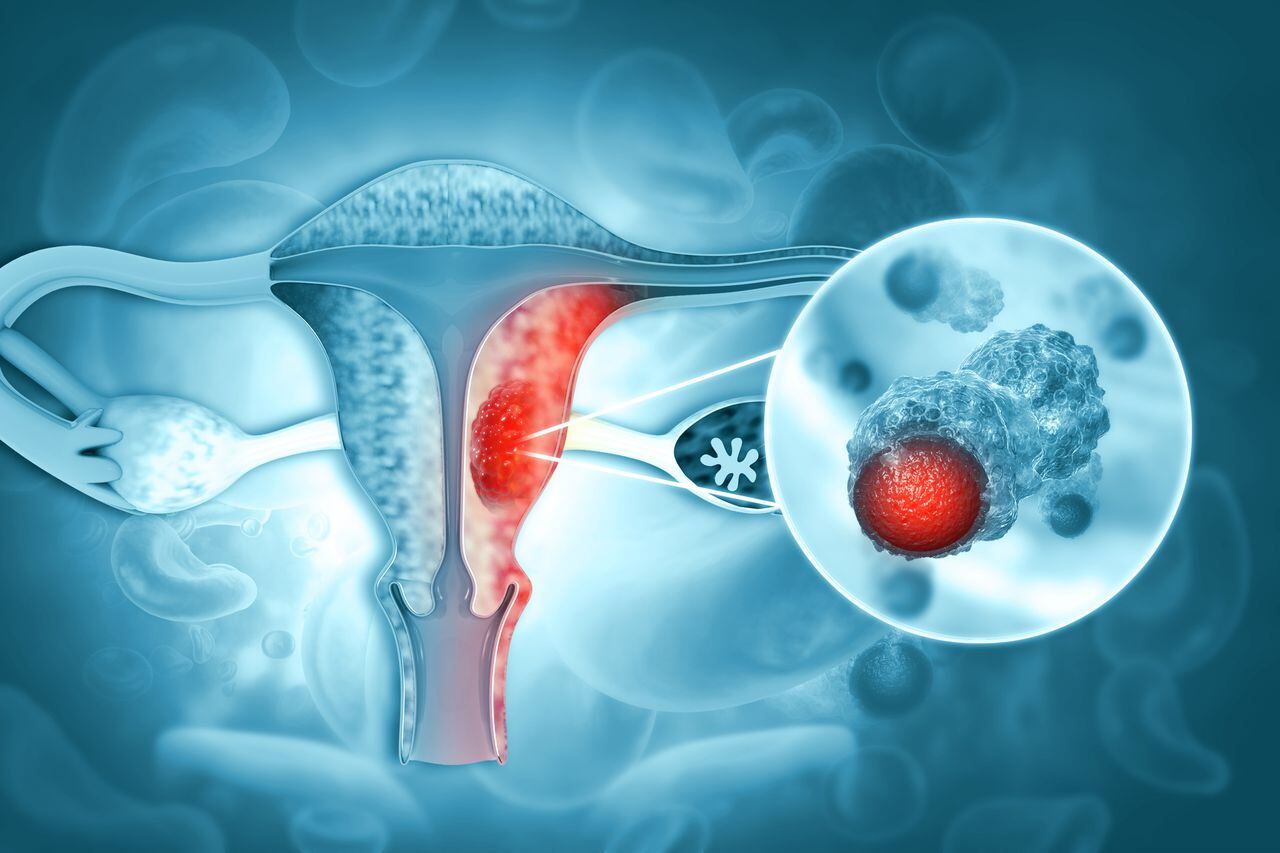 Enfermedades del sistema reproductivo femenino.cáncer de útero y tumor maligno de endometrio como concepto médico uterino.