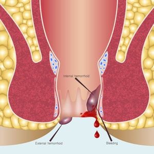 Las hemorroides pueden generar graves y dolorosas ulceraciones.
