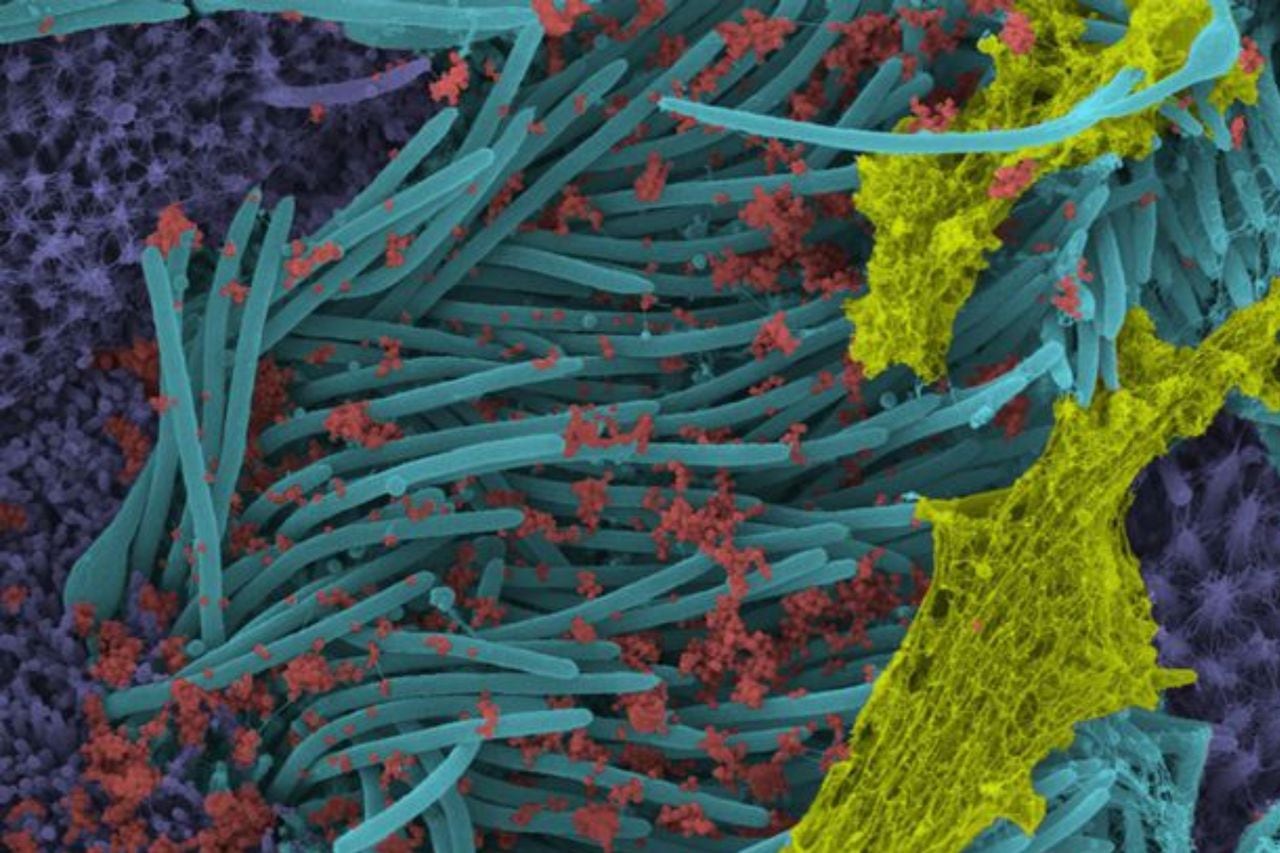 Una imagen de aumento de mayor potencia muestra la estructura y densidad de los viriones del Sars-CoV-2 (de color rojo) producidos por los epitelios de las vías respiratorias humanas. Los viriones son la forma infecciosa completa del virus liberado a las superficies respiratorias por las células huésped infectadas.