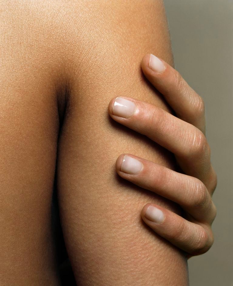 ¿Qué tipo de piel es más propensa al cáncer?