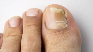 Los hongos en las uñas producen una decoloración blanca, café o amarilla; también puede hacer que se engrosen o quiebren. Foto: GettyImages.