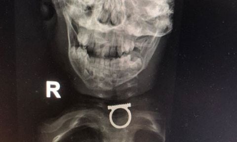 Médicos lograron extraer sin complicaciones el anillo incrustado en la garganta del menor.