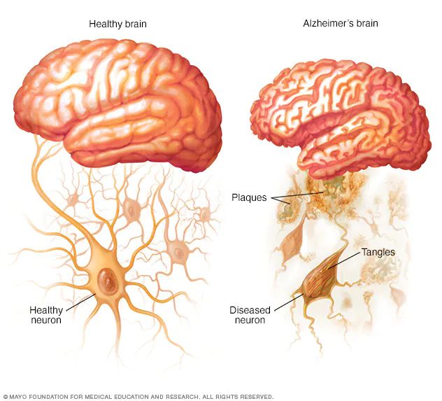 Mayo Clinic explica que el daño comienza más a menudo en la región del cerebro que controla la memoria. Luego la pérdida de neuronas se extiende en un patrón algo predecible a otras regiones del cerebro. En la etapa avanzada de la enfermedad, el tejido cerebral está considerablemente reducido.