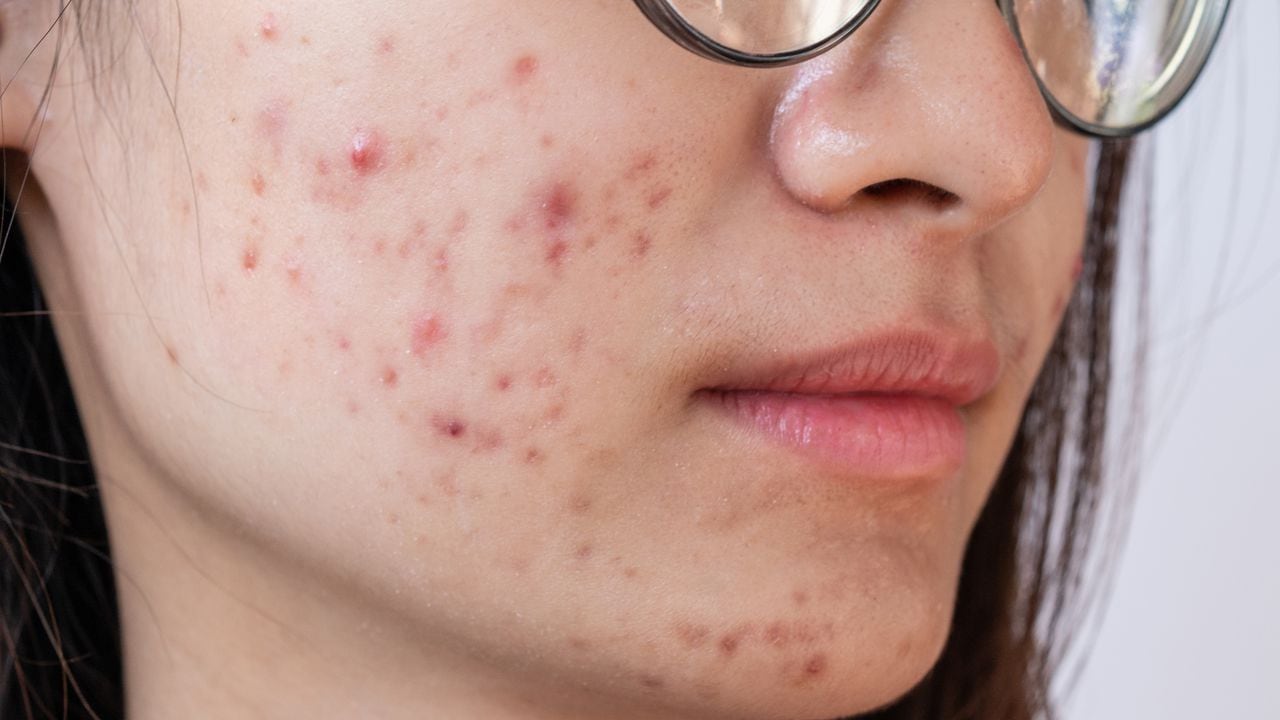 El acné es un trastorno de la piel, según la Clínica Mayo.