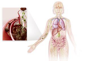 El tejido linfático se encuentra en muchas partes del cuerpo, de modo que el linfoma de Hodgkin puede originarse en casi todas las partes del cuerpo.