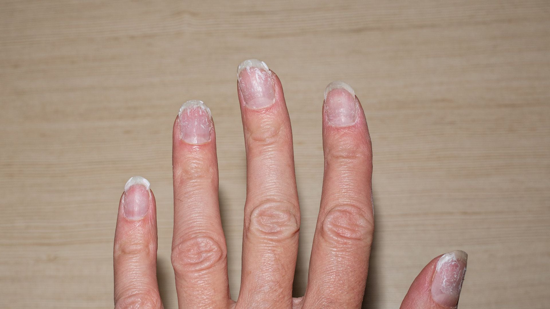 Las enfermedades que causan que las uñas cambien de color