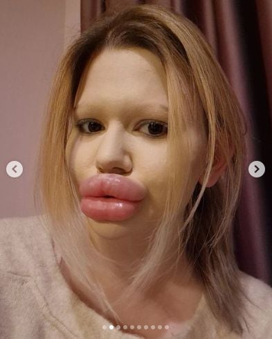 Andrea Ivanova ha gastado 8.000 euros en la transformación de sus labios.