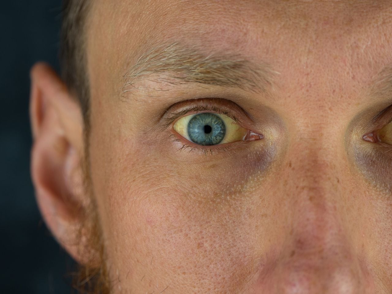 Según la American Cancer Society el cáncer de ojo se deriva en varios tipos.