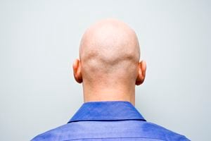 También conocida como alopecia. Foto: Getty Images.