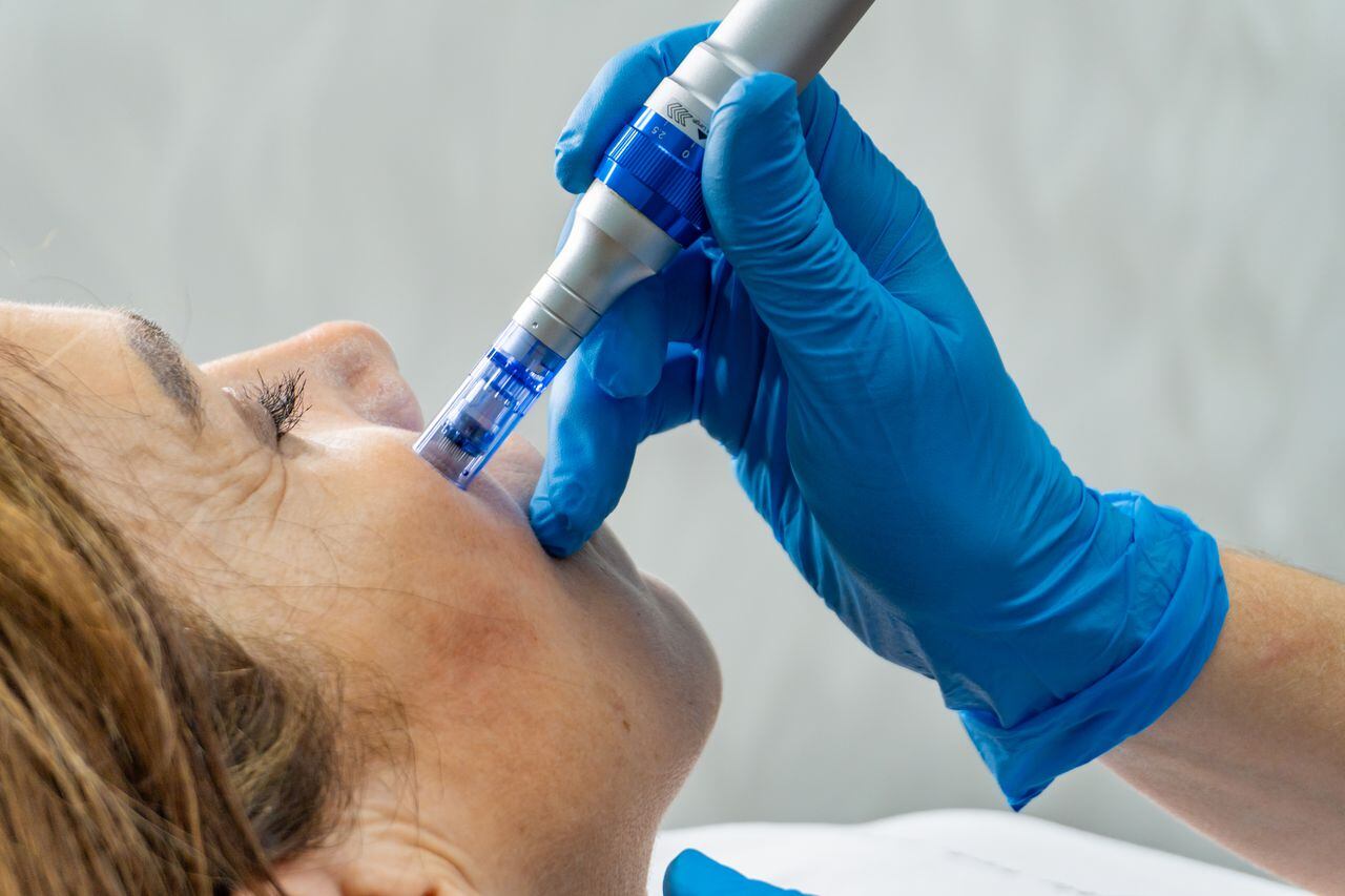 Primer plano de una mano con guantes azules usando un bolígrafo con microagujas en la cara de una mujer mayor durante un tratamiento cosmético, imagen de referencia