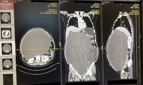 Foto de la radiografía del impresionante tumor que tenía la mujer en el abdomen.