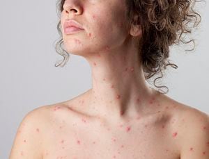La varicela es un virus contagioso que puede permanecer ene l cuerpo de una a dos semanas.