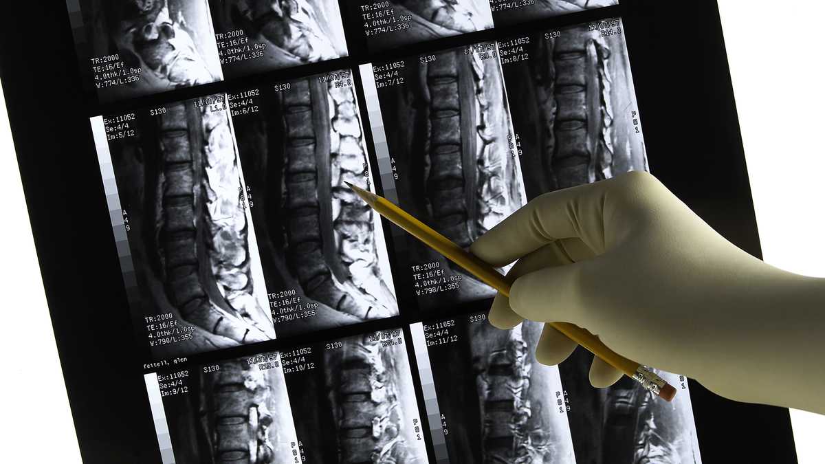 La falta de calcio puede producir osteoporosis. Foto: Getty Images