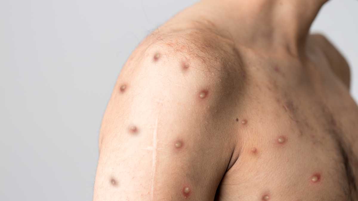 WHAT TO DO IF YOU HAVE MONKEYPOX?