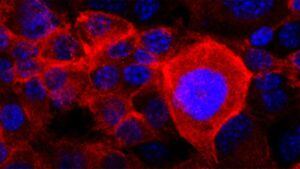 La mayoría de las células de cáncer de páncreas tienen mutaciones en el gen KRAS que permiten un crecimiento no regulado. En esta imagen, la versión mutante y cancerígena de la proteína KRAS se tiñe de rojo en las células de cáncer de páncreas.
DEREK CHENG/TUVESON LAB/CSHL, 20
  (Foto de ARCHIVO)
23/6/2021