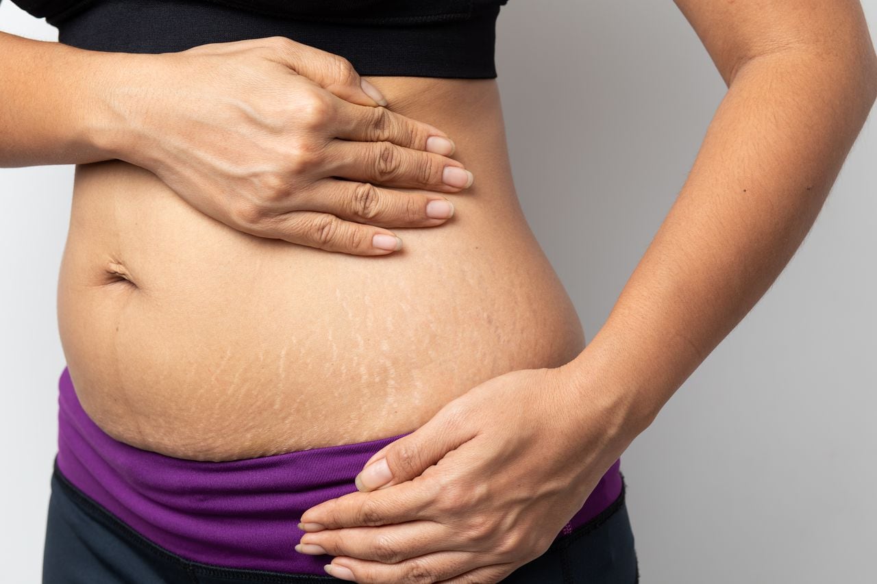 For example, stretch marks often appear due to immediate weight gain and loss.