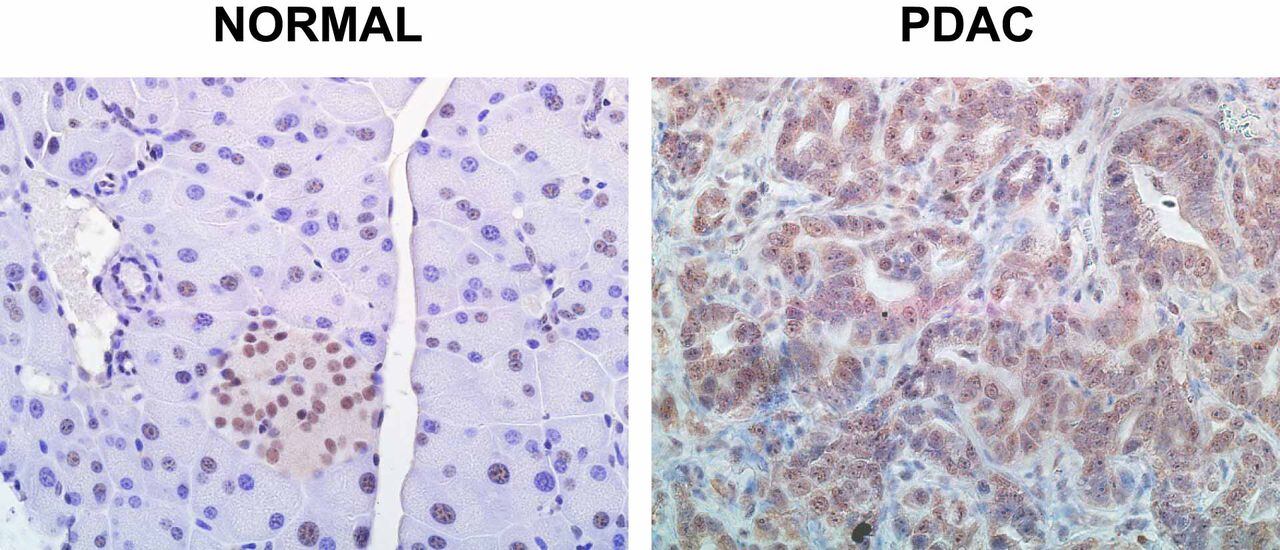 Las células pancreáticas sanas normales mantienen un nivel constante de SRSF1 (teñido de rojo), pero en PDAC, esos niveles aumentan sin control.