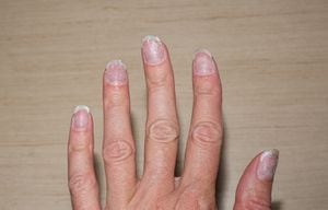 Las uñas frágiles y quebradizas pueden presentarse por una mala alimentación o alguna enfermedad.